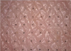 micropoint-penetrated-skin-site
